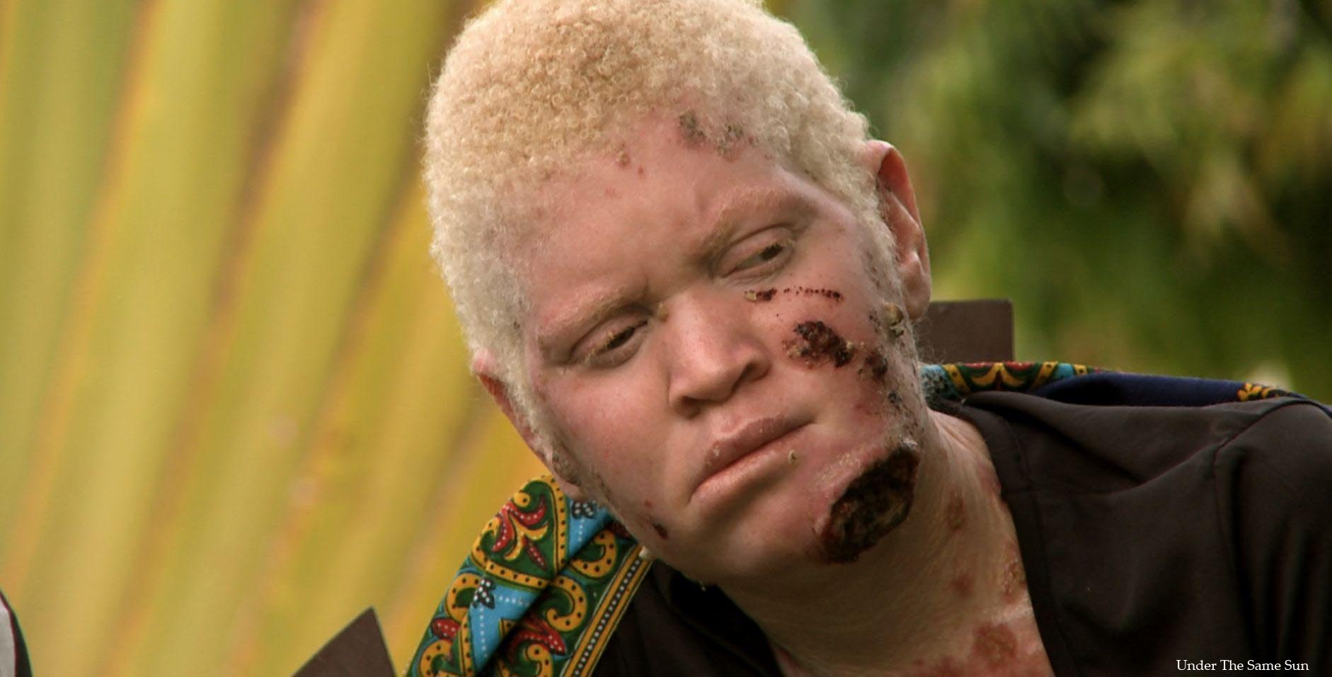 You thanks Albino black girl sex Albino black girl sex